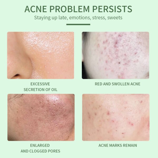 Anti-acne essence