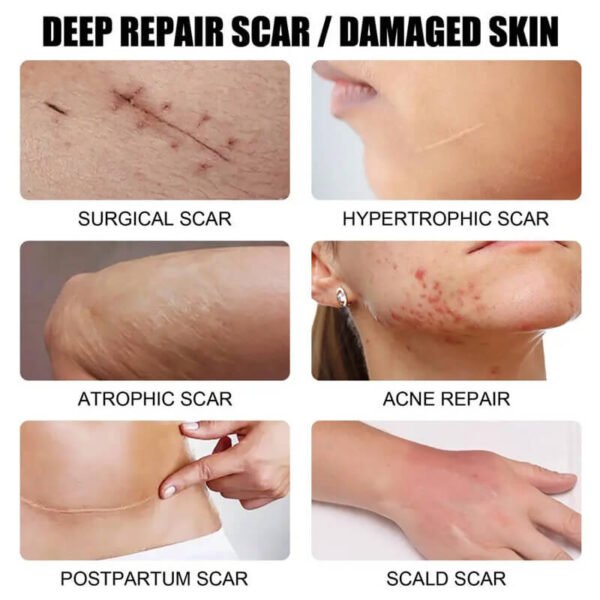 Scar Removal Cream