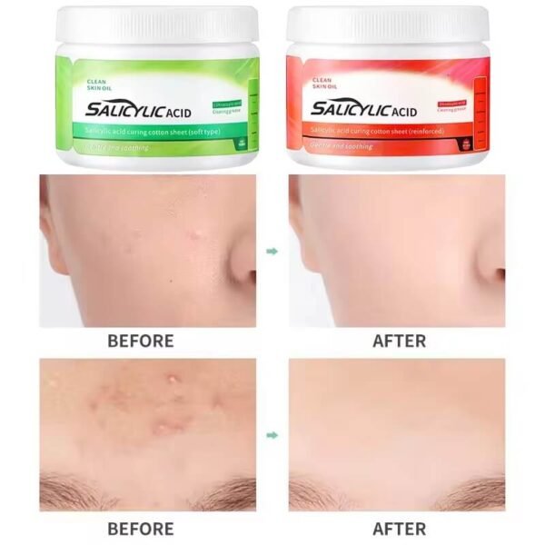 Salicylic Acid Pads