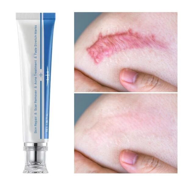 Scar Removal Cream