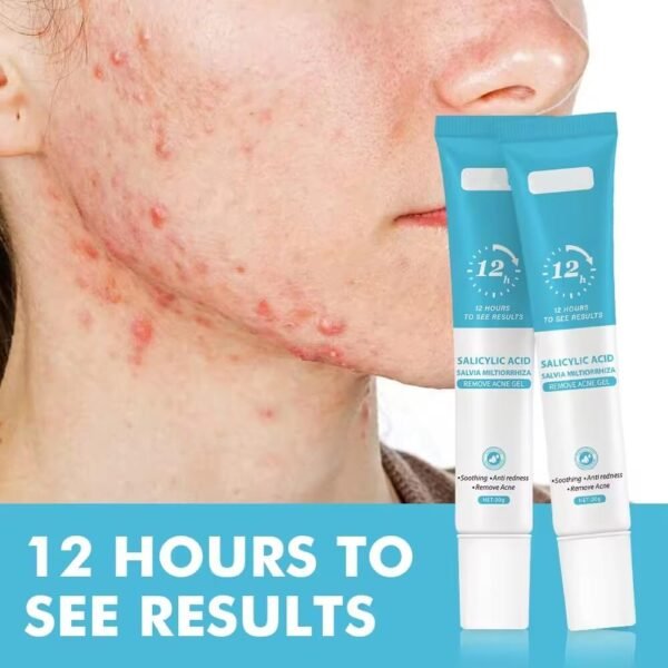 Salicylic Acid Acne Gel